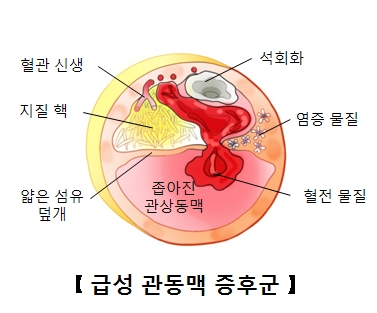 석회화 염증물질 혈전물질 좁아진 관상동맥 얇은섬유 덮개 지질핵 혈관신생의 위치및 급성 관동맥 증후군의 예시