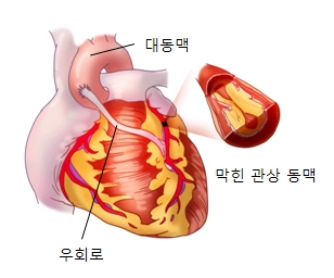 대동맥 막힌광상동맥 우회로등을 예시