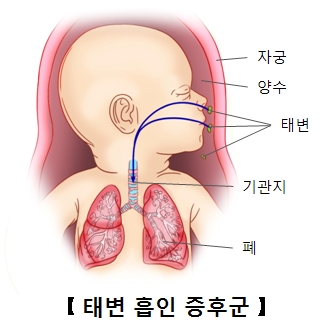 태변흡인증후군에걸린태아 및 자궁 양수 위치및 태아의 기관지 폐 위치