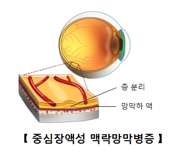 망막의후극부에액체가축적되어망막이박이되었음