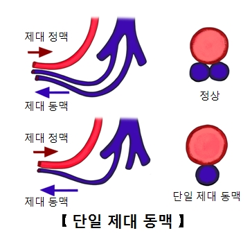 정상적인제대동맥과단일제대동맥 그림 예시