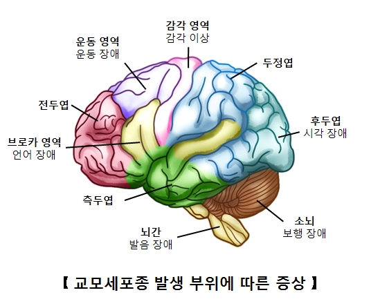 브로카영역(언어장애) 전두엽 운동영역(운동장애) 감각영역(감각이상) 두정엽 후두엽(시각장애) 소뇌(보행장애) 뇌간(발음장애) 측두엽등 교모세포종 발생 부위에 따른 증상의 예시