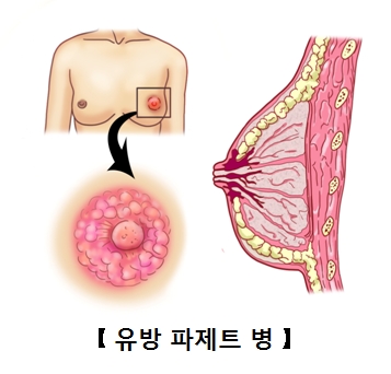 파제트병에걸린 유방과유두