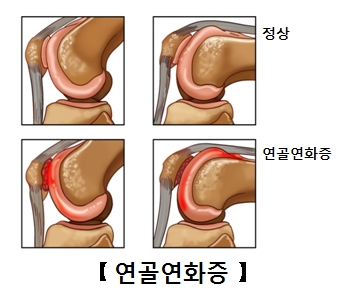 정상적인연골과연골연화증에걸린연골