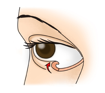 눈꺼플이 눈으로 말려들어가 속눈썹이 각막에지속적으로 자극을 주고있음
