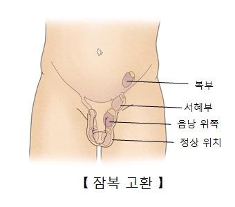 정상고환의 위치와 음낭위쪽 서혜부 복부쪽에 위치한 잠복 고환의 예시