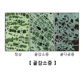 골감소증의정상,골감소증,골다공증의고밀도측정사진