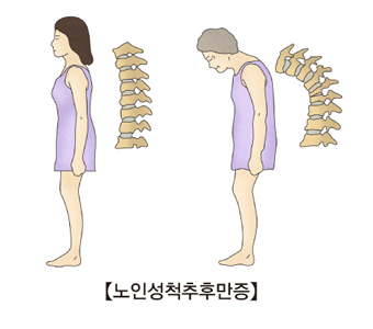 정상여자가서있는자세와척추모양및노인성척추후만증에걸린노인의자세와척추