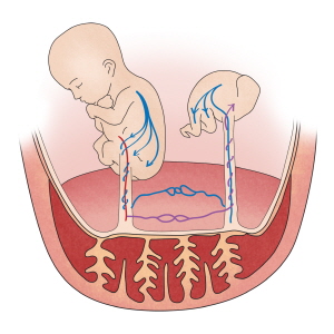 태아의 중추신경계및 위장관계기형으로 인한 양수과다증이 발생하는 모습
