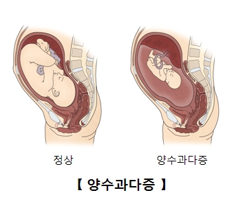 정상적으로 임신한 태아의모습과 양수과다증으로 태아가 양수에 잠겨있는 모습 예시