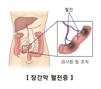 혈전 괴사된 장조직등 장간막 혈전증의 예시