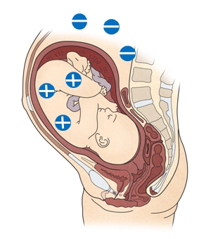 임산부가 Rh 음성이고 태아는 Rh 양성인 자궁안 모습