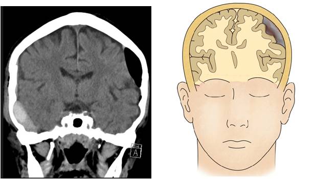 x-ray 로 본 기뇌증의 사진과, CT로 본 뇌 검사 모습