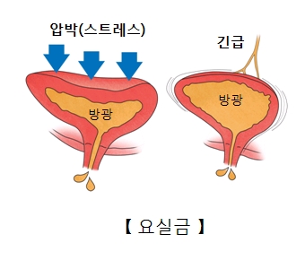 요실금