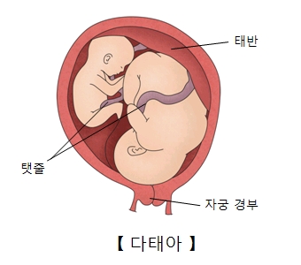유산후 계속되는 임신(다태)