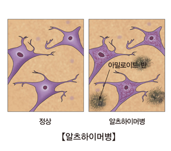 알쯔하이머 병