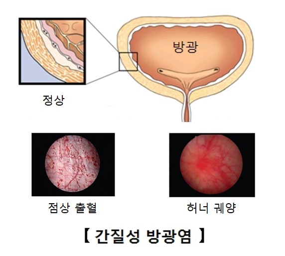 질환백과 | 의료정보 | 건강정보 | 서울아산병원