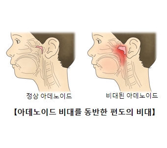 아데노이드의 비대를 동반한 편도의 비대