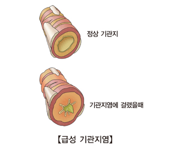 재발성 천명