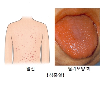 성홍열 | 질환백과 | 의료정보 | 건강정보 | 서울아산병원