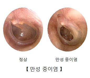 만성 중이염