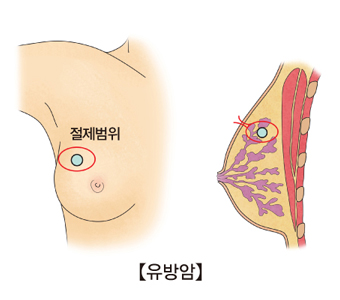 유방 종양