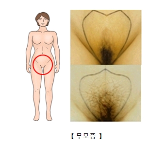 무모증
