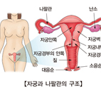 자궁경부암