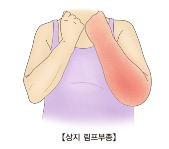 암재활 