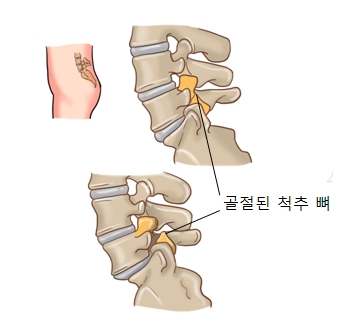 척추분리증 