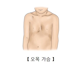 오목가슴 증상
