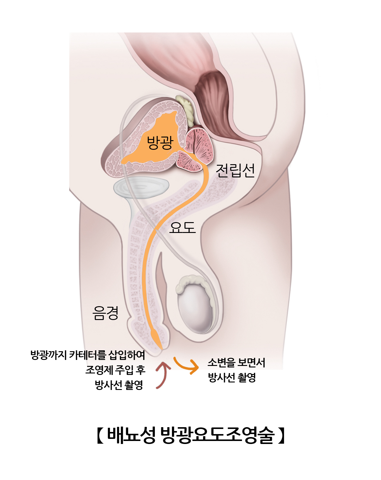 배뇨성방광요도조영술