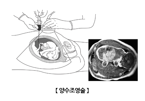 양수조영술