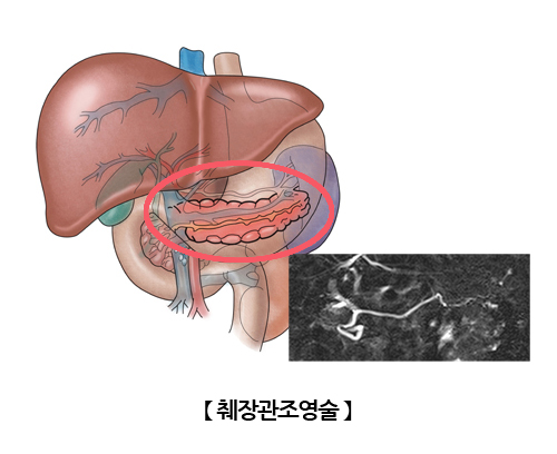 췌장관조영술