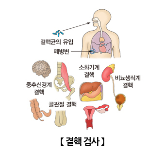 결핵