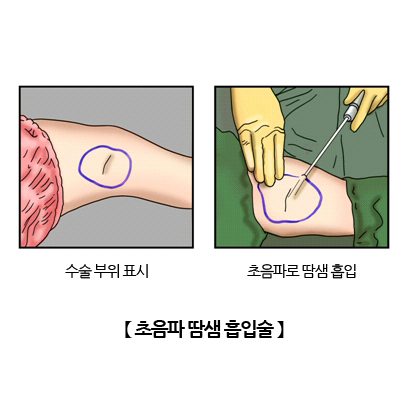 초음파 땀샘 흅입술