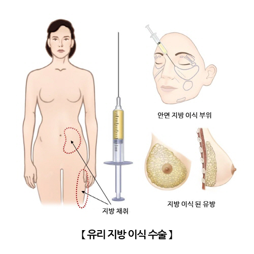 유리 지방 이식 수술