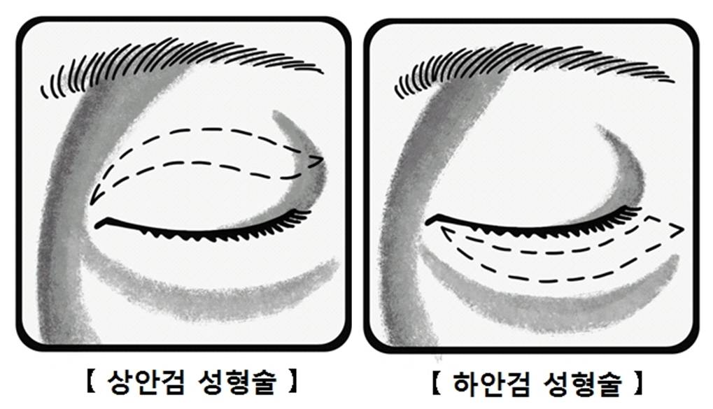 안검하수 교정 수술