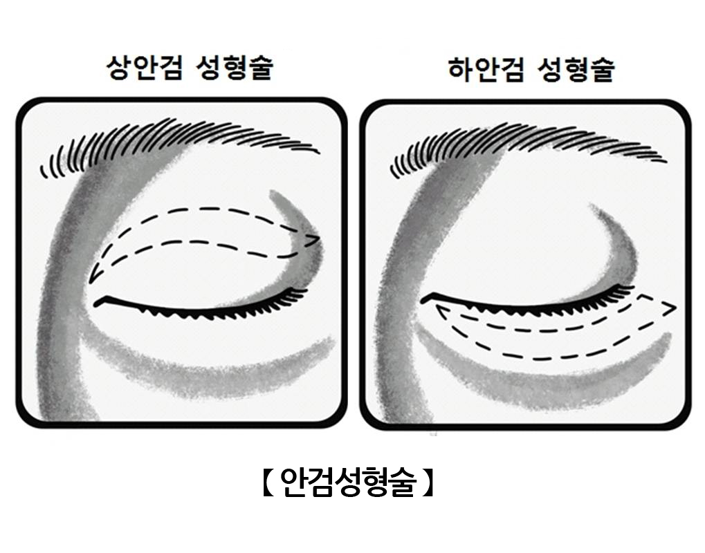 안검성형술