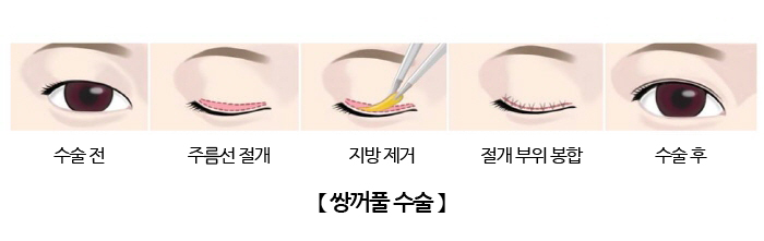 쌍꺼풀 수술