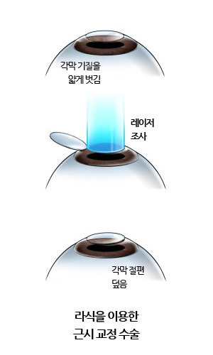 라식을 이용한 근시 교정 수술