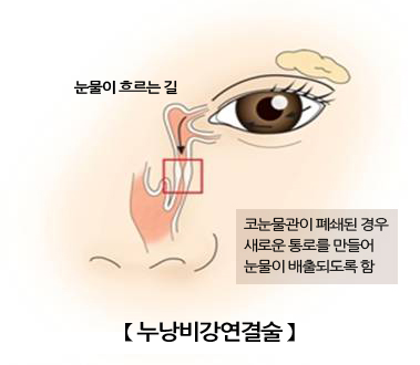 누낭비강연결술
