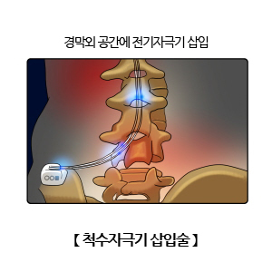 척수자극기 삽입술
