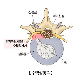 수핵성형술