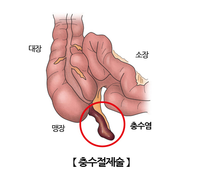 충수절제술