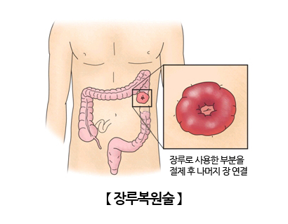 장루복원술