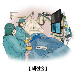 색전술