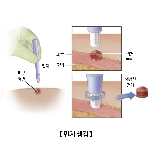 펀치 생검
