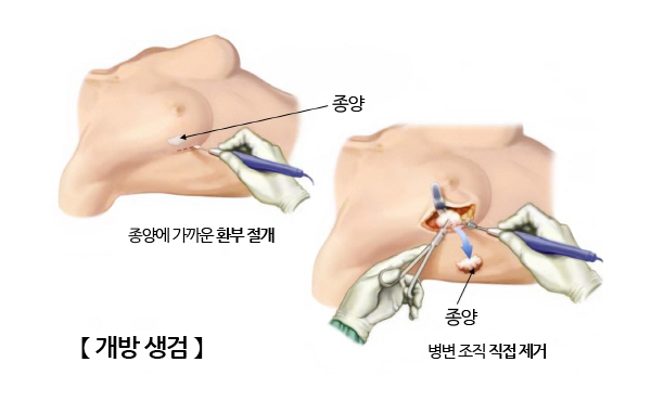개방 생검