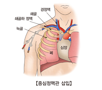 중심정맥관 삽입